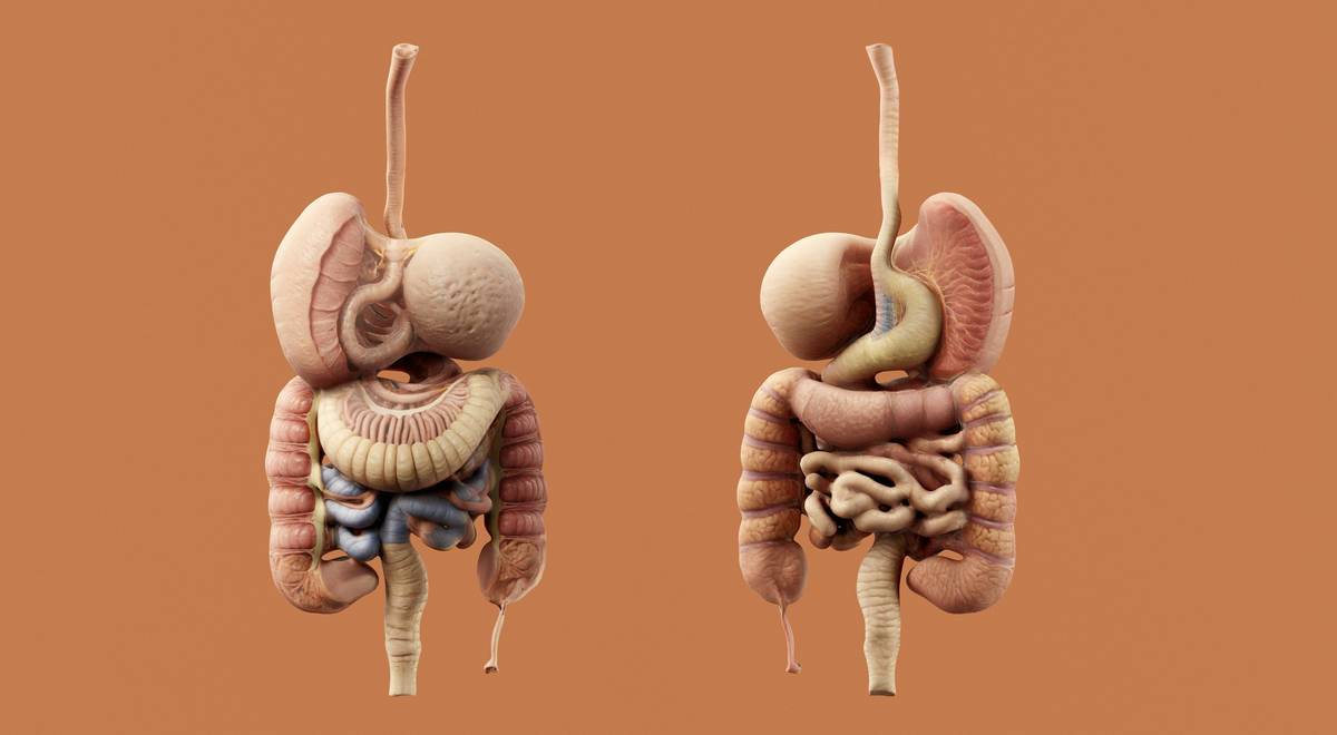 Diagram showing healthy vs. leaky gut lining with tight junctions open, allowing toxins into bloodstream